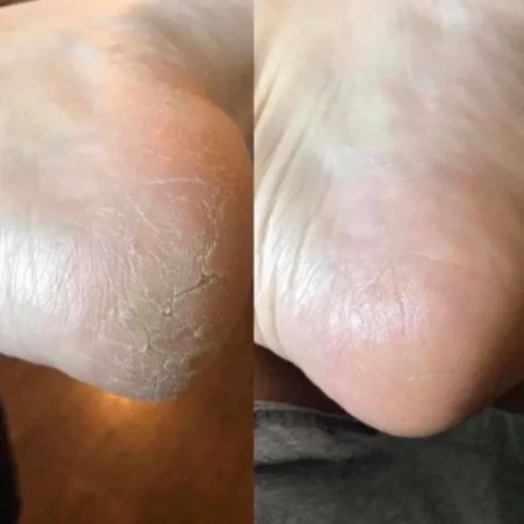 - (2) TWO Epoch NuSkin Sole Solution foot treatment